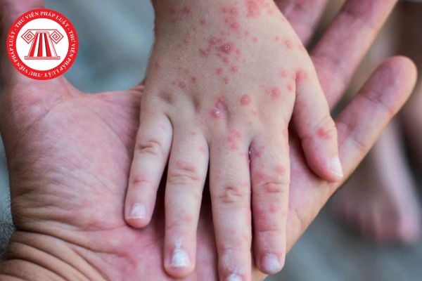 🩺 TĂNG CƯỜNG PHÒNG CHỐNG BỆNH SỞI